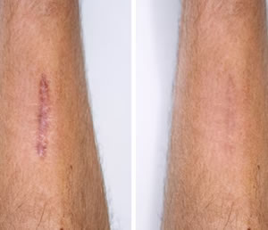Dermapen 1